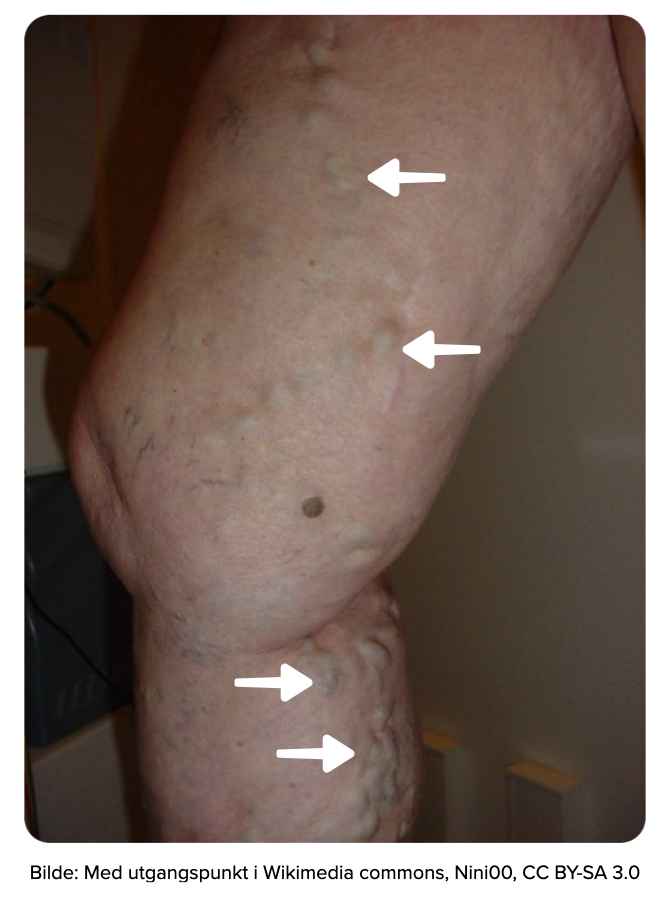 Bilde av pasient med tydelige varicer i beinet.